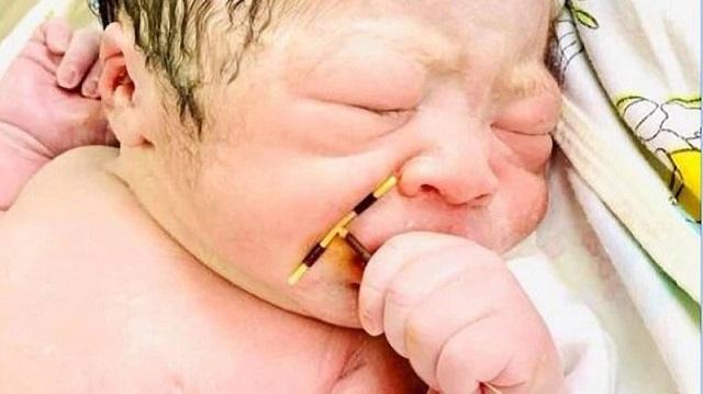Ребенок родился с внутриматочной спиралью мамы в руках