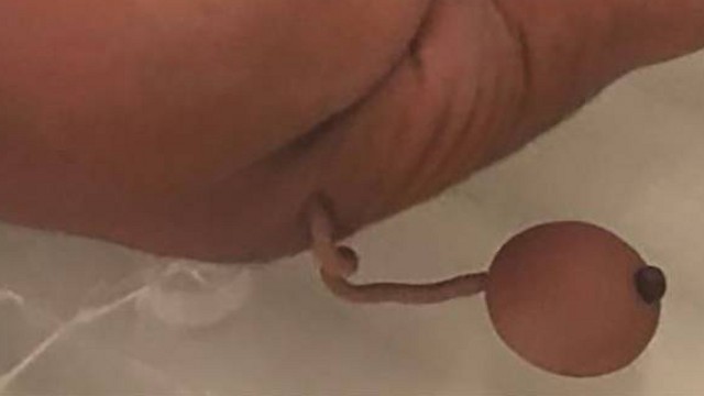 Новорожденный напугал врачей 12-сантиметровым хвостиком