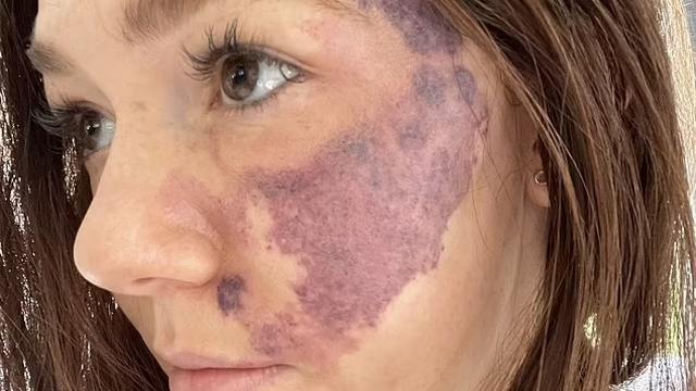 Женщина пять лет скрывала от жениха родимое пятно на лице