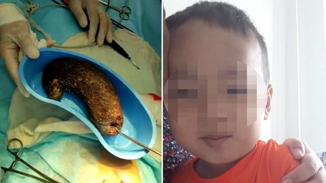 Полтора кг волос извлекли из желудка четырёхлетнего казахстанца