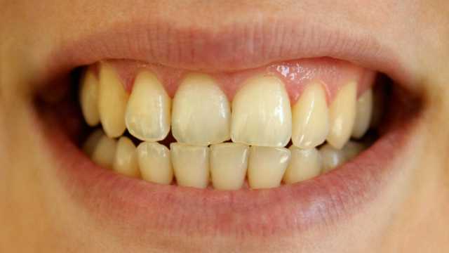 Причины появления жёлтого налёта на зубах и способы устранения