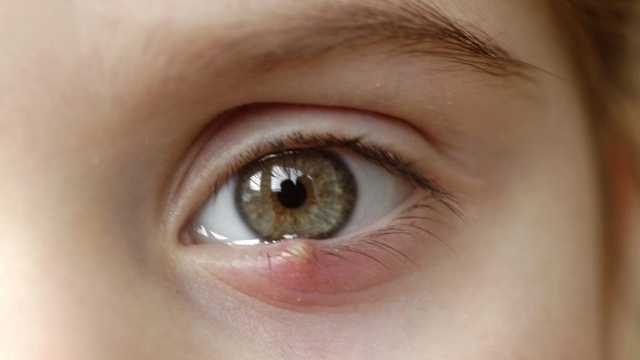 Не болезнь, а проклятие: как вылечить ячмень на глазу