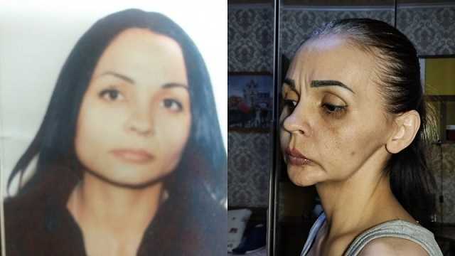 Жительнице Атырау испортили лицо в результате пластической операции