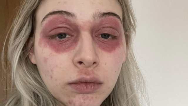 Лицо девушки обезобразилось после косметической процедуры