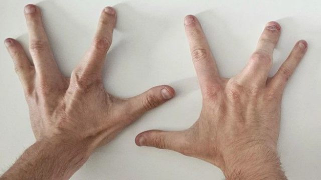Мужчина родился с четырьмя пальцами на каждой руке