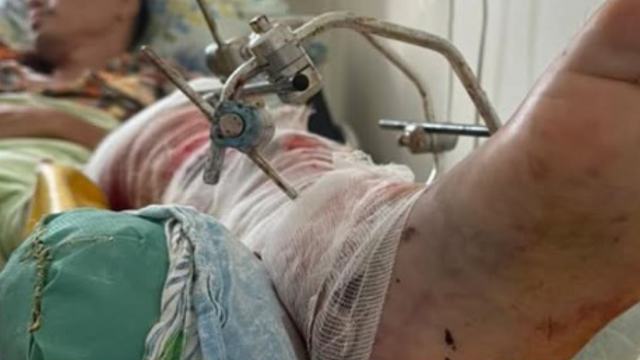 Пострадавшего на автозаводе костанайца долечат в Астане