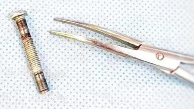 Врачи спасли малышку, проглотившую 4-сантиметровый болт