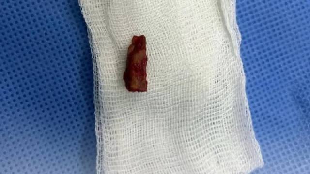 10-летний мальчик полжизни ходил с куском ветки в голове