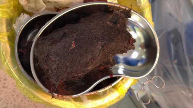 Килограмм волос нашли в желудке у 15-летней девочки